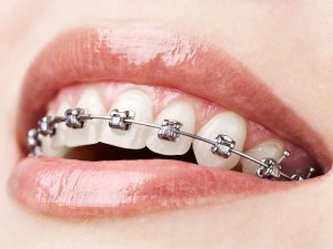tratamiento-ortodoncia1